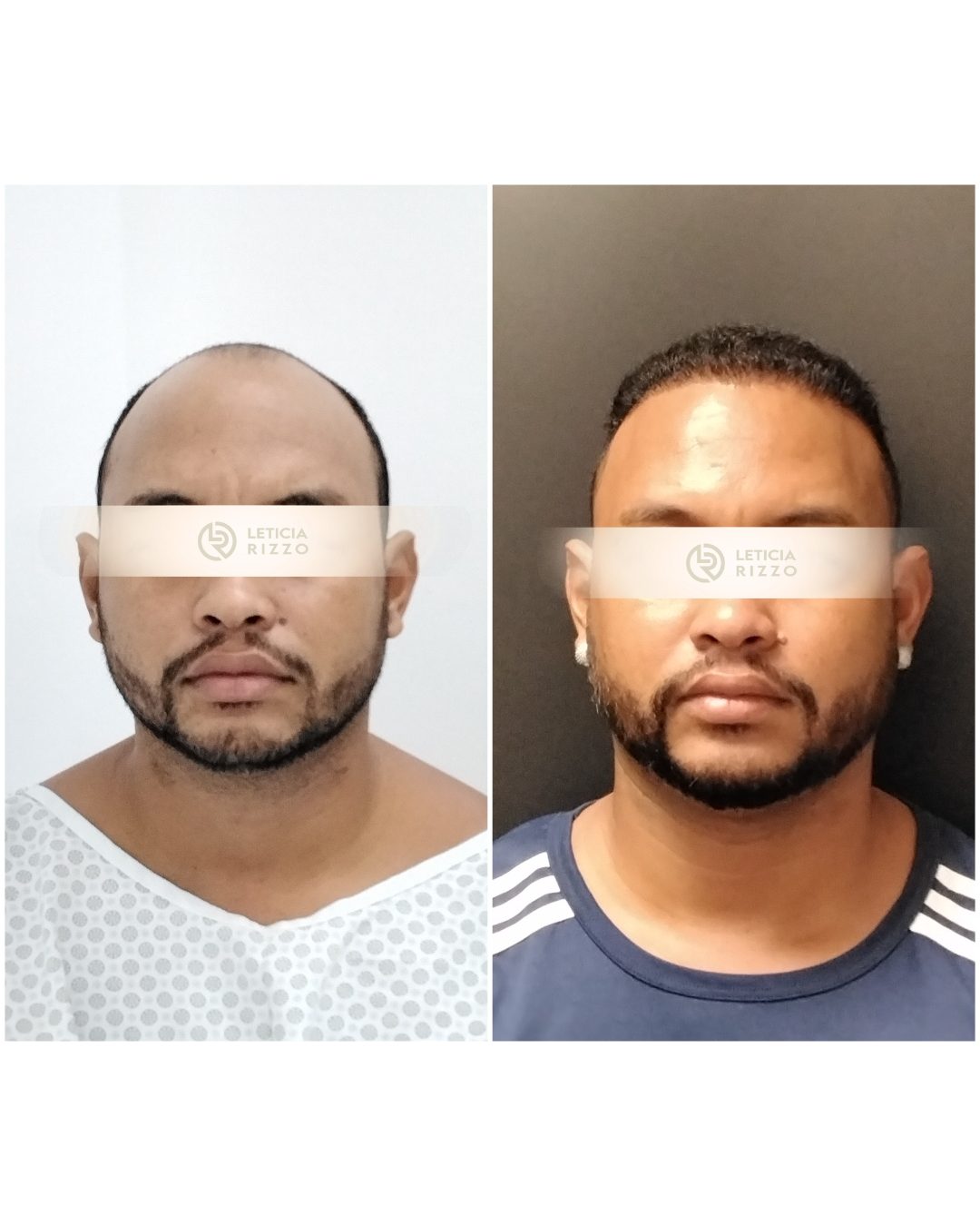 Antes e depois de transplante capilar FUE: cobertura de entradas, paciente da Dra. Letícia Rizzo