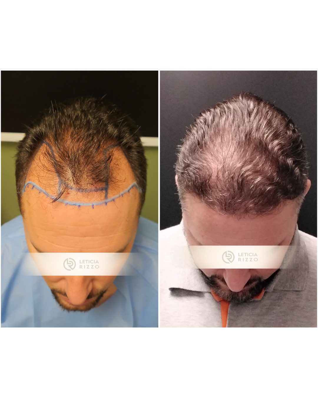 Antes e depois de transplante capilar FUE: reconstrução da linha frontal, paciente da Dra. Letícia Rizzo